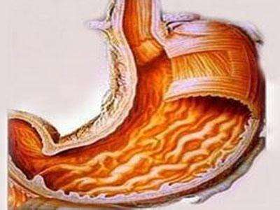 慢性淺表性胃炎
