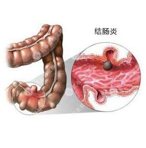 潰瘍性結(jié)腸炎