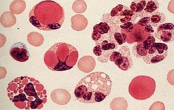 系統(tǒng)性紅斑狼瘡