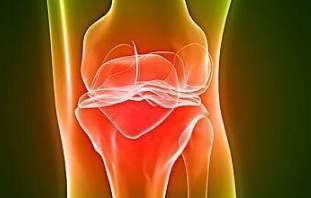 骨關(guān)節(jié)炎