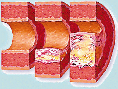 動(dòng)脈粥樣硬化