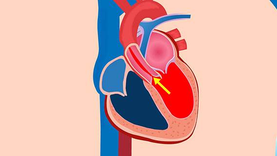 主動(dòng)脈瓣關(guān)閉不全