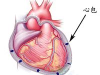 心包炎