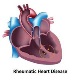 風(fēng)濕性心臟瓣膜病
