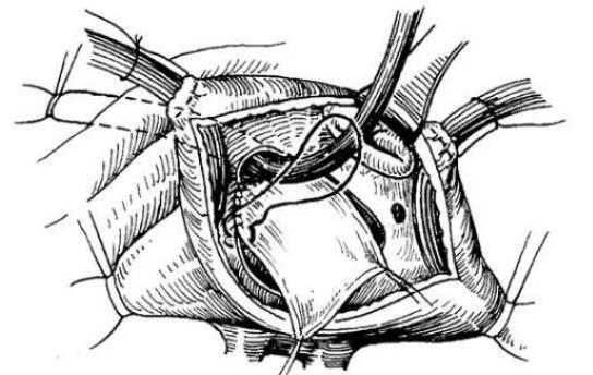 無(wú)頂冠狀靜脈竇綜合征