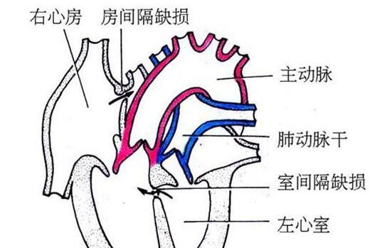 心內(nèi)膜墊缺損