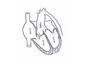 主動脈竇動脈瘤破裂