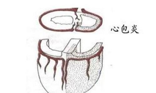 結(jié)核性心包炎