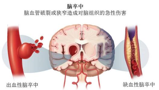 出血性腦卒中