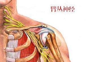 臂叢神經(jīng)痛