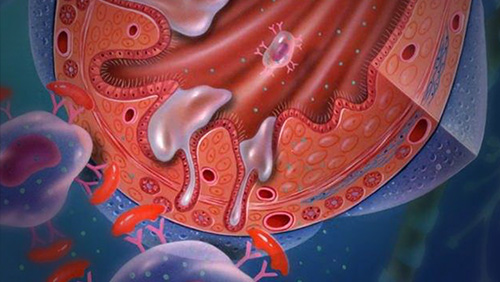 視神經(jīng)脊髓炎