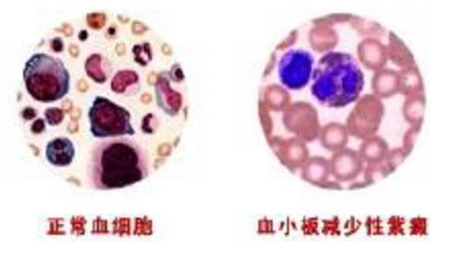 血小板減少性紫癜