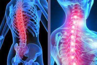 強(qiáng)直性脊柱炎