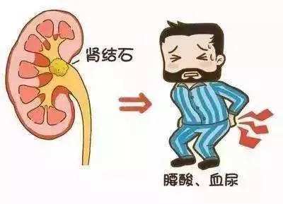 腎結(jié)石