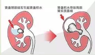 腎性尿崩癥