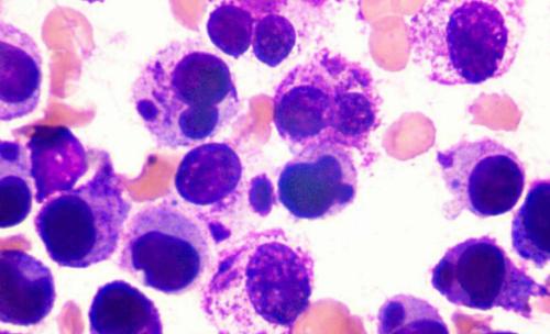 嗜酸性粒細(xì)胞增多癥