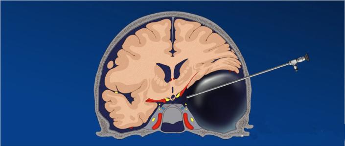 蛛網(wǎng)膜囊腫