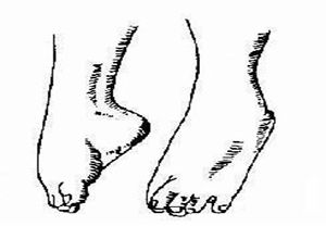 維生素D缺乏性手足搐搦癥