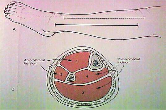 骨筋膜室綜合征