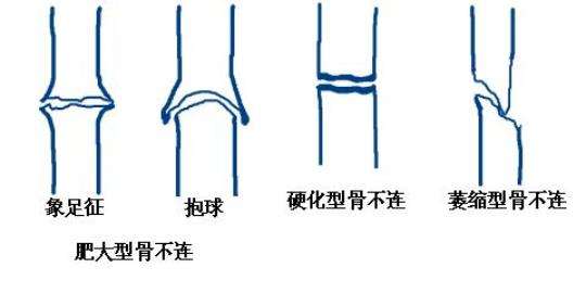 骨不連