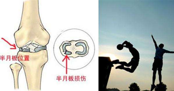 膝關(guān)節(jié)半月板損傷