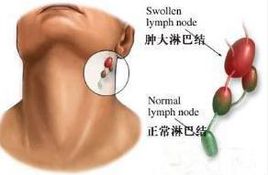 淋巴轉(zhuǎn)移癌