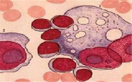 口腔頜面部毛細管型淋巴管瘤