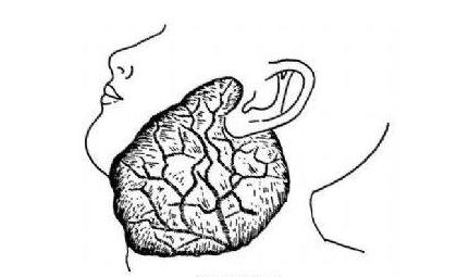 口腔頜面部血管瘤