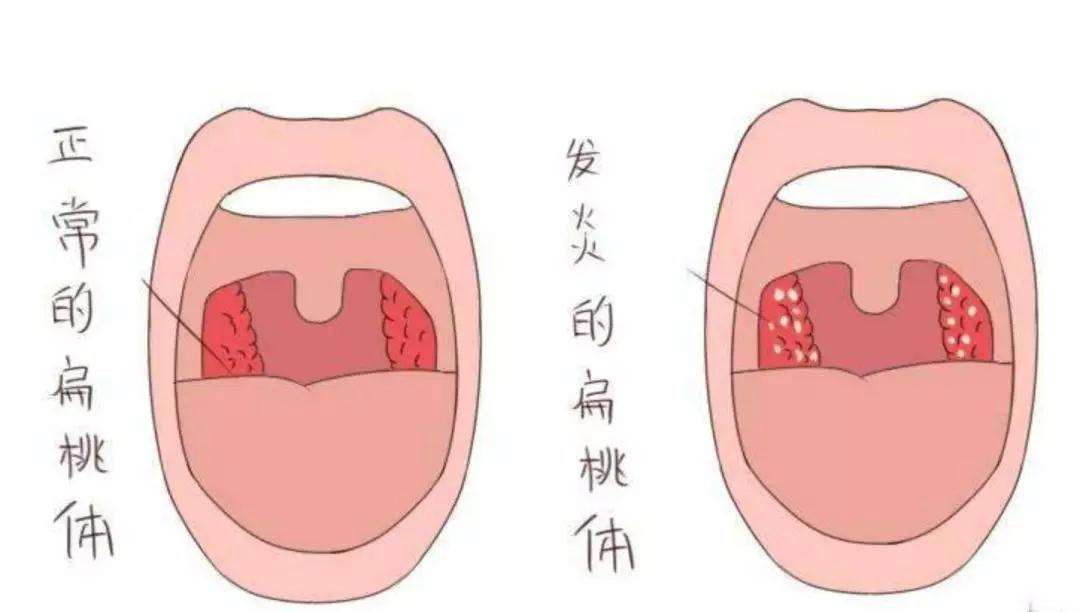 扁桃體惡性腫瘤