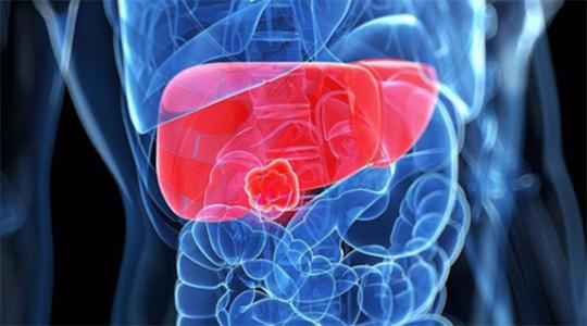 繼發(fā)性肝癌