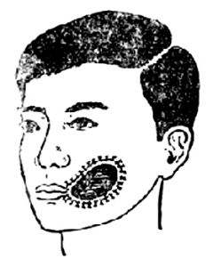 口腔頜面部損傷