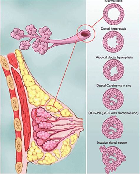 乳腺導(dǎo)管內(nèi)乳頭狀瘤