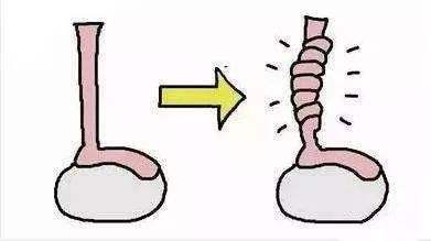 睪丸扭轉(zhuǎn)