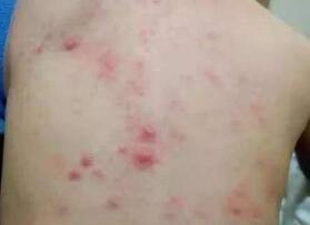 小兒病毒性皮疹