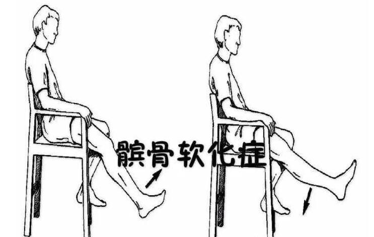 髕骨軟骨軟化癥