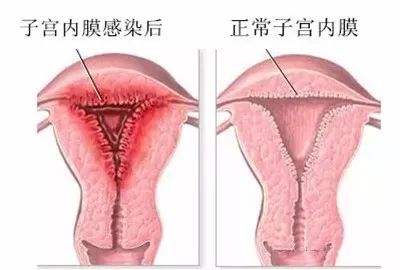 子宮內(nèi)膜息肉