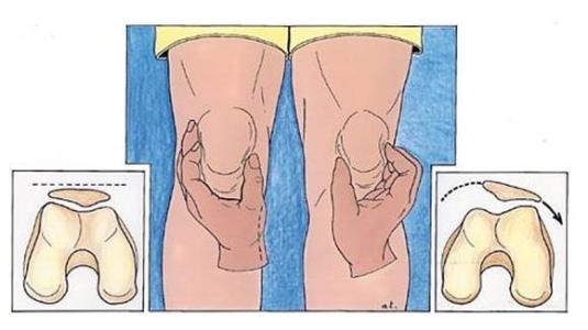 髕骨脫位